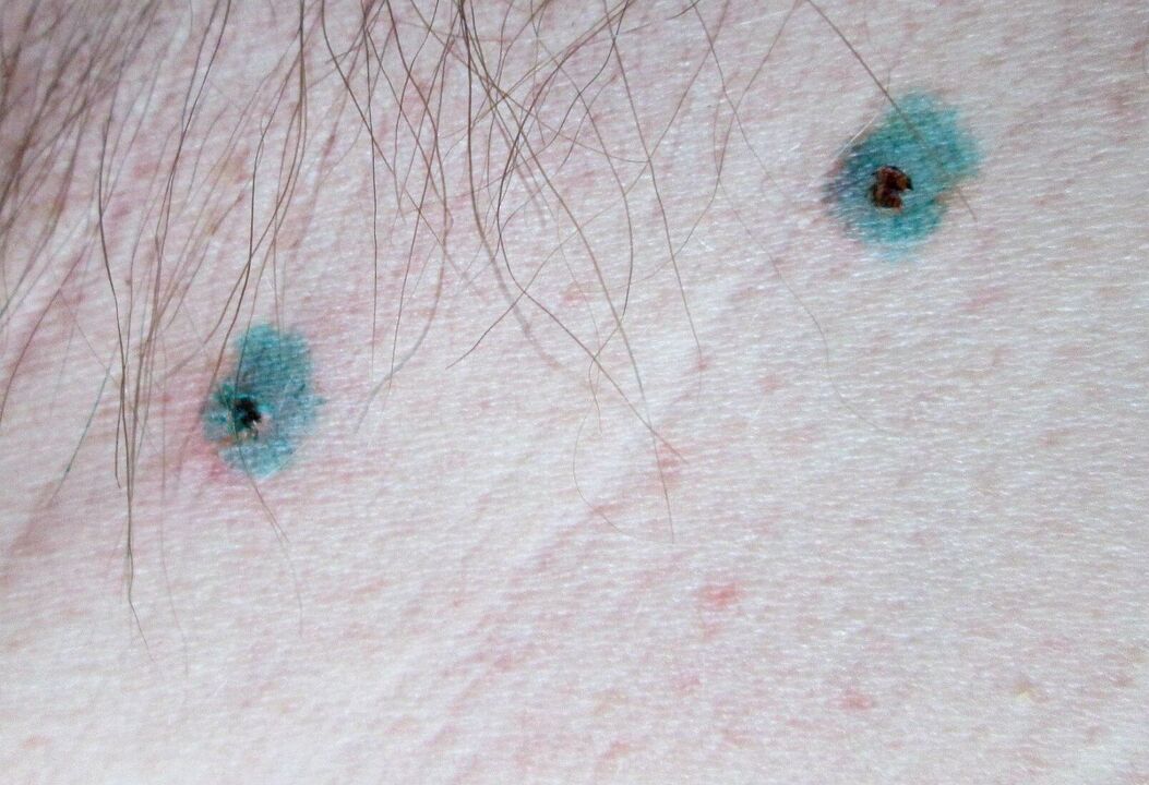 Macchie sulla pelle dopo la rimozione laser dei papillomi